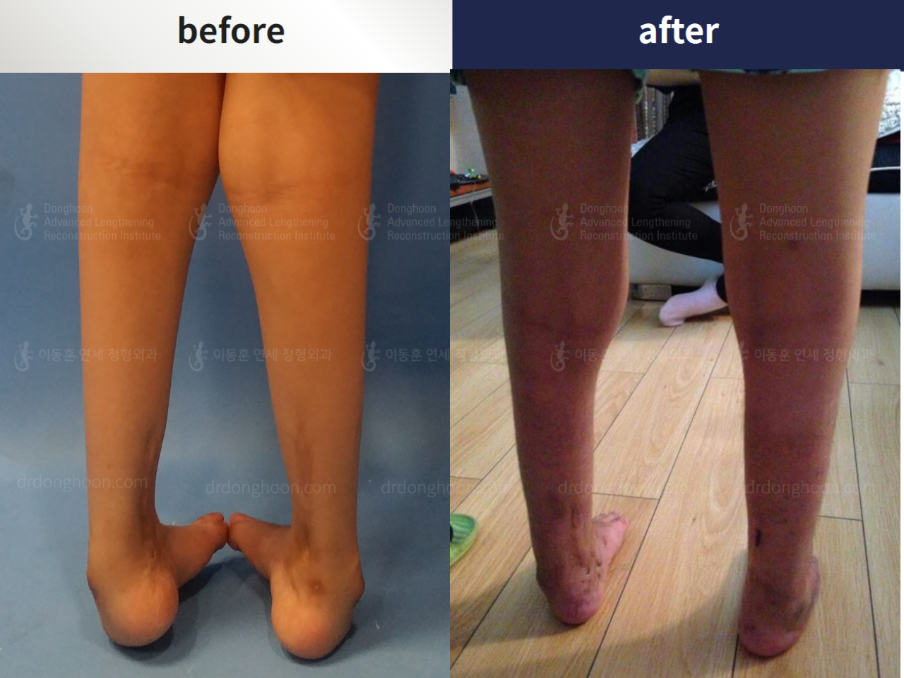 Before and after foot & ankle deformity, case 4367968, image 3, Dr. Donghoon institute (DALRI)