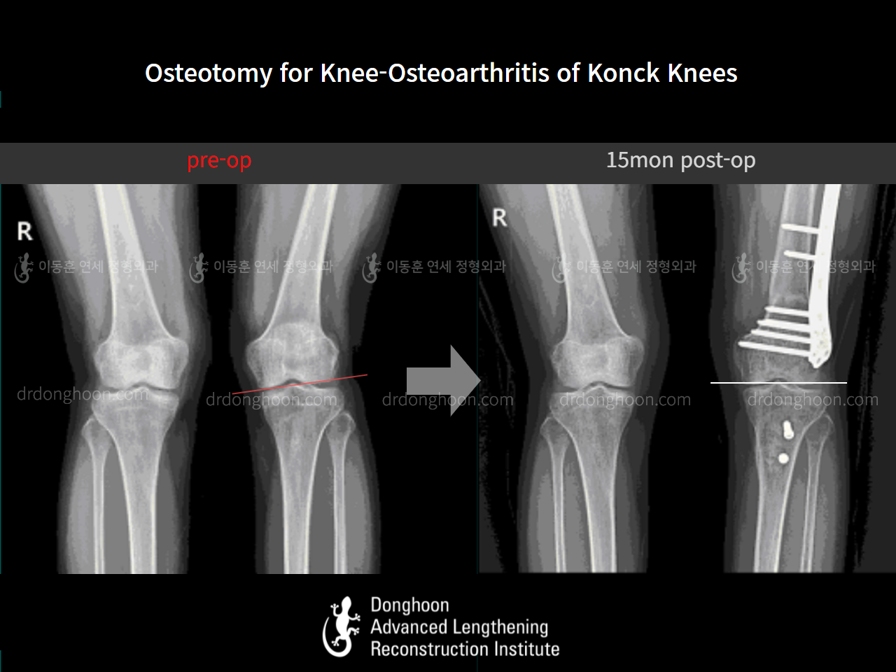 Before and after adult knock knees, case 10868300, image 3, Dr. Donghoon institute (DALRI)