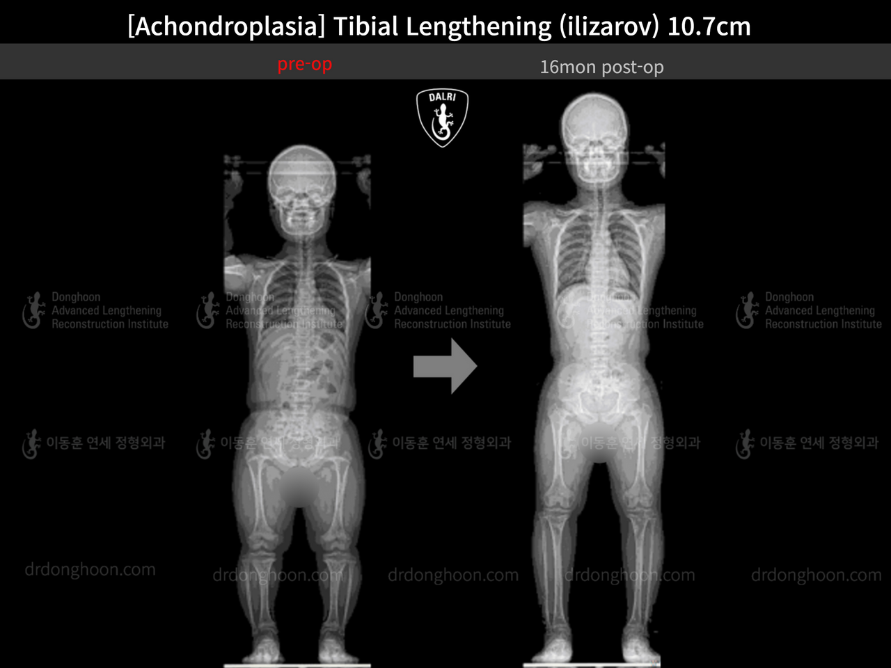 Before and after paediatric congenital condition, case 13489647, image 11, Dr. Donghoon institute (DALRI)