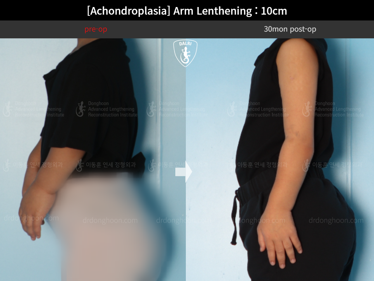 Before and after arm lengthening, case 14602820, image 3, Dr. Donghoon institute (DALRI)