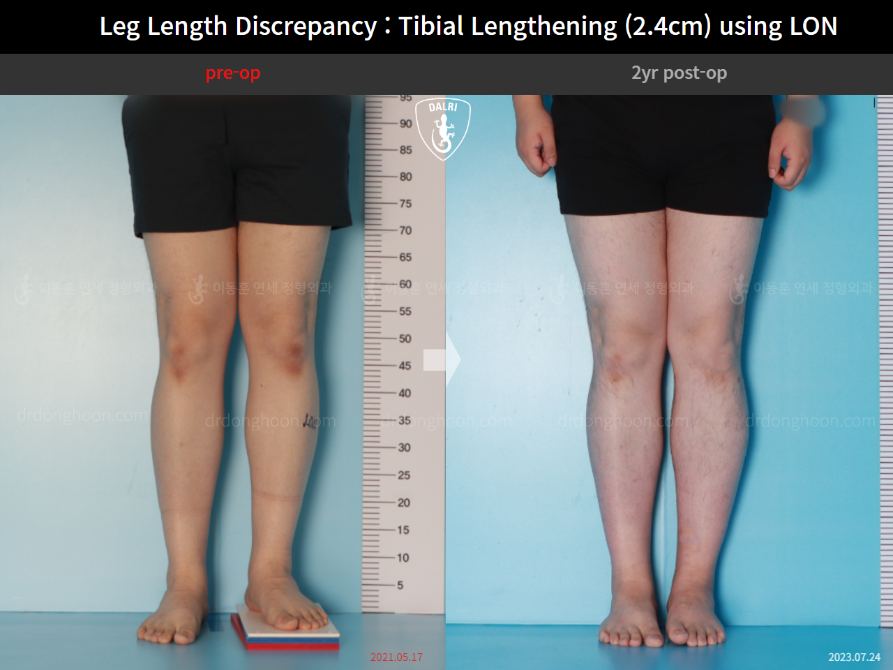Before and after adult lld, case 15877698, image 5, Dr. Donghoon institute (DALRI)