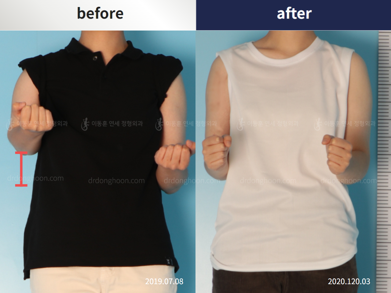 Before and after arm lengthening, case 5456644, image 1, Dr. Donghoon institute (DALRI)