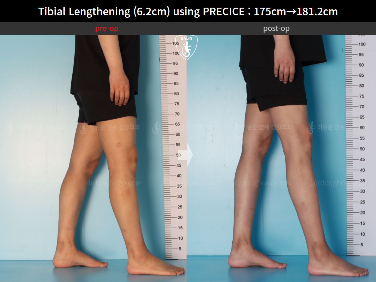 Before and after cll precice, case 16277428, image 12, Dr. Donghoon institute (DALRI)