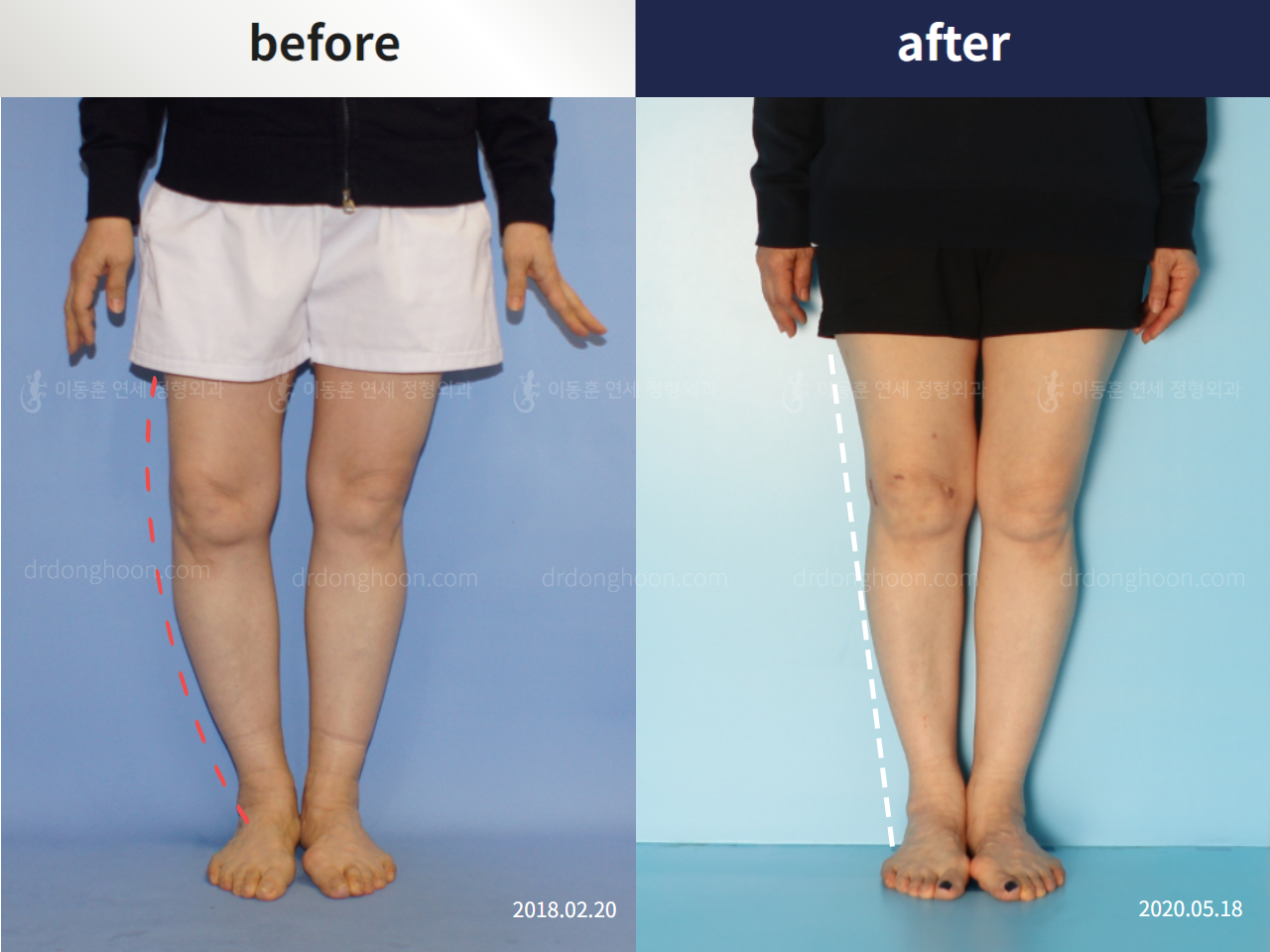 Before and after osteotomy for knee osteoarthritis, case 5409745, image 2, Dr. Donghoon institute (DALRI)