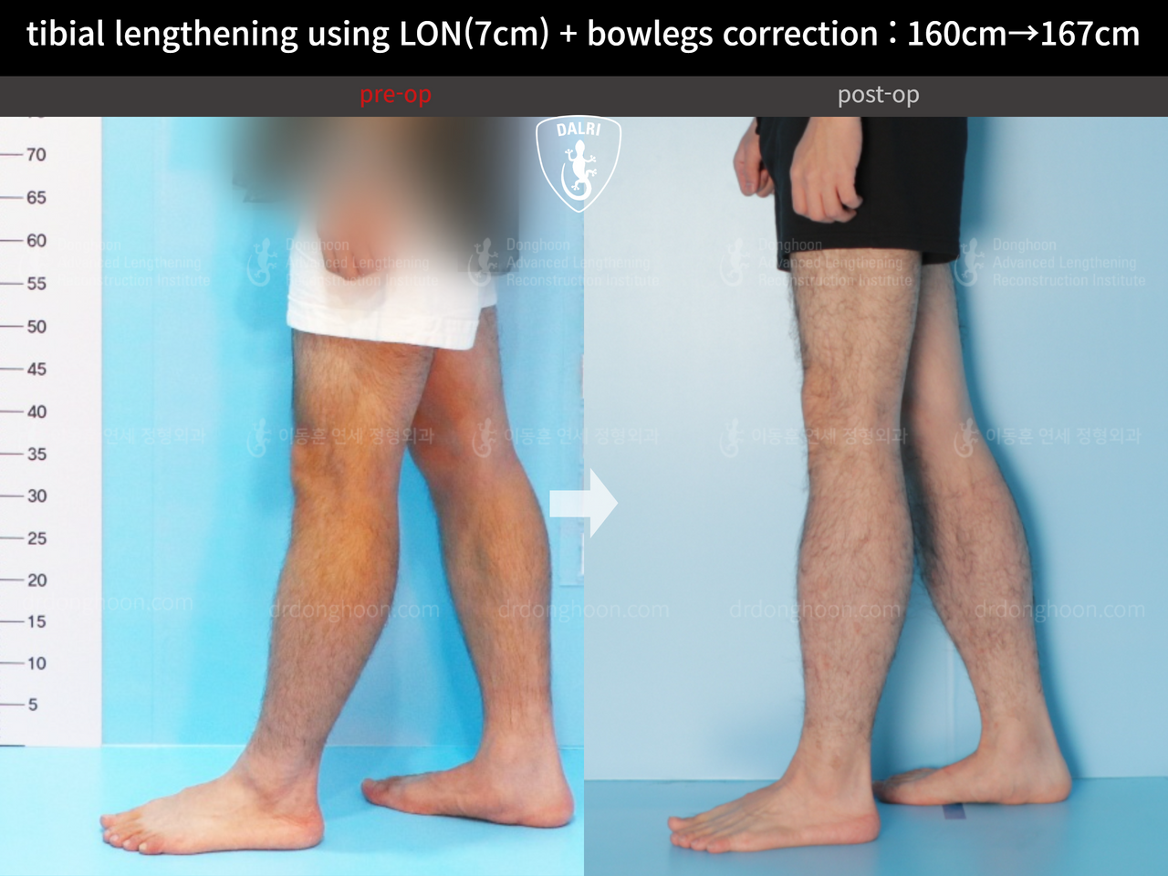 Before and after cll + deformity correction, case 13241722, image 7, Dr. Donghoon institute (DALRI)