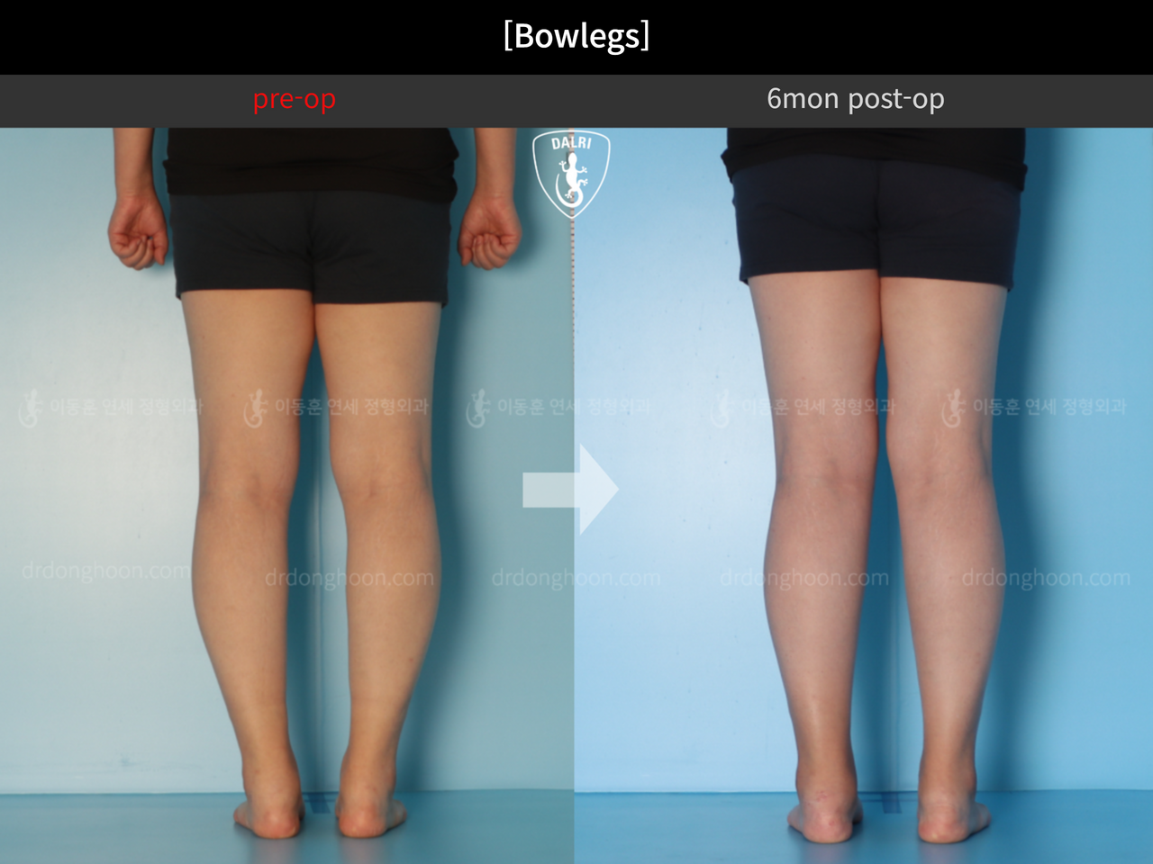 Before and after adult bowlegs, case 12396052, image 8, Dr. Donghoon institute (DALRI)