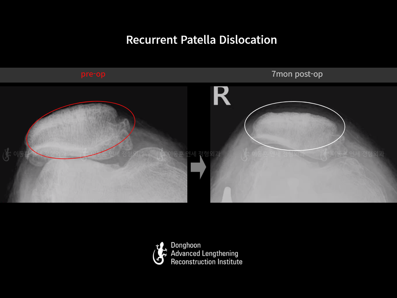 Before and after recurrent patella dislocation, case 16147031, image 15, Dr. Donghoon institute (DALRI)