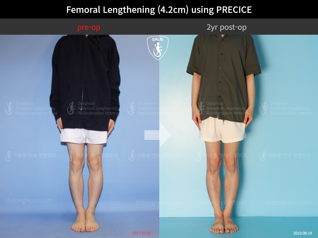 Before and after cll precice, case 4323396, image 1, Dr. Donghoon institute (DALRI)