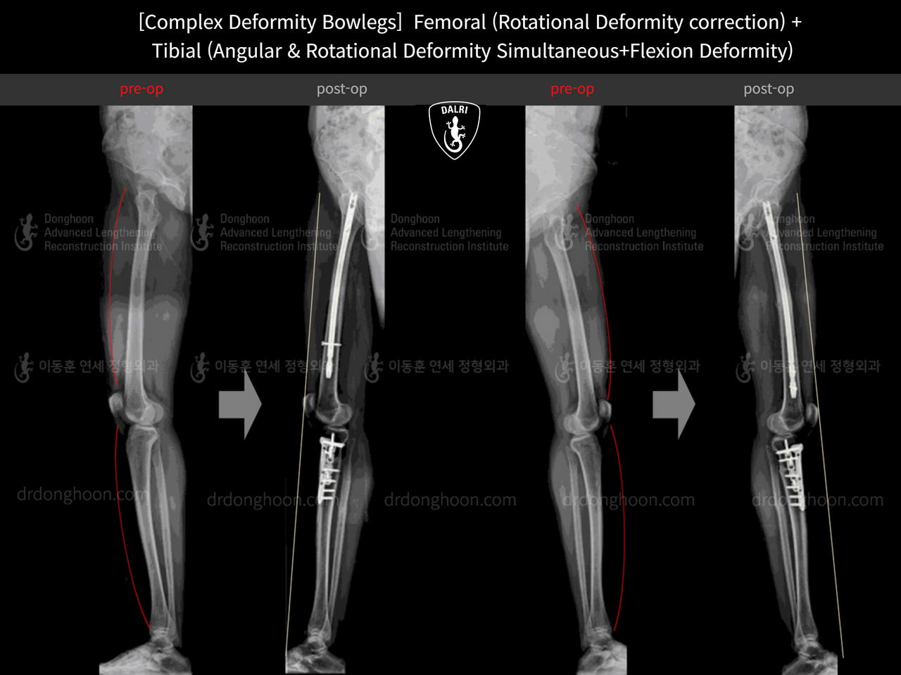Before and after complex deformity, case 13185732, image 5, Dr. Donghoon institute (DALRI)