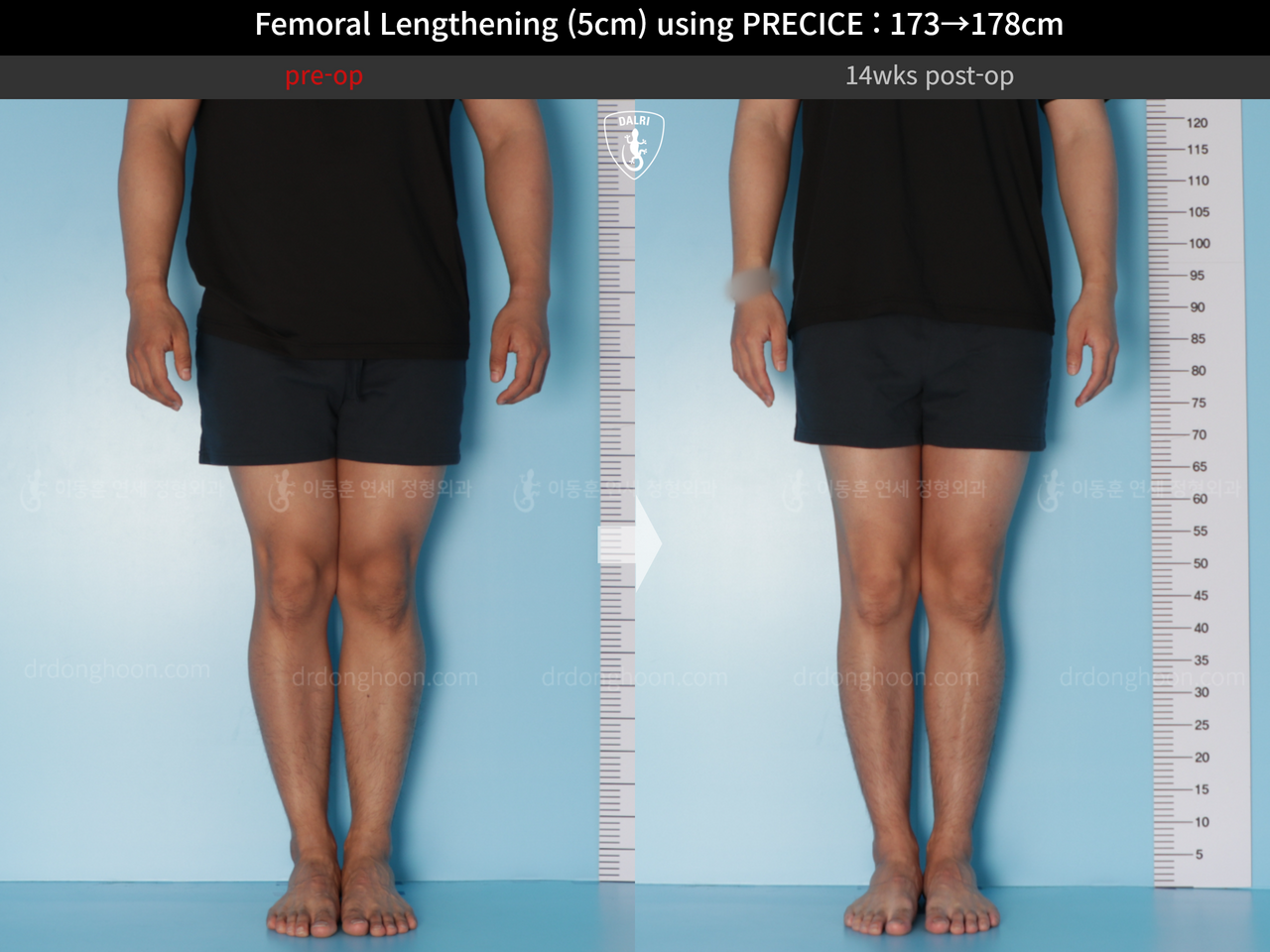 Before and after cll precice, case 14448457, image 5, Dr. Donghoon institute (DALRI)