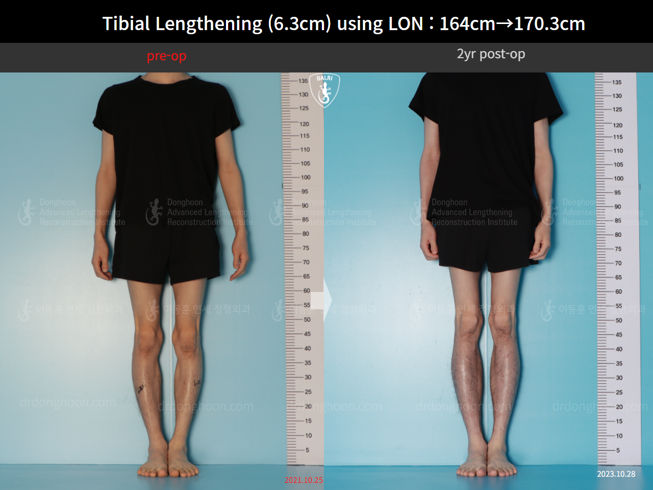 Before and after cll lon, case 16723608, image 1, Dr. Donghoon institute (DALRI)