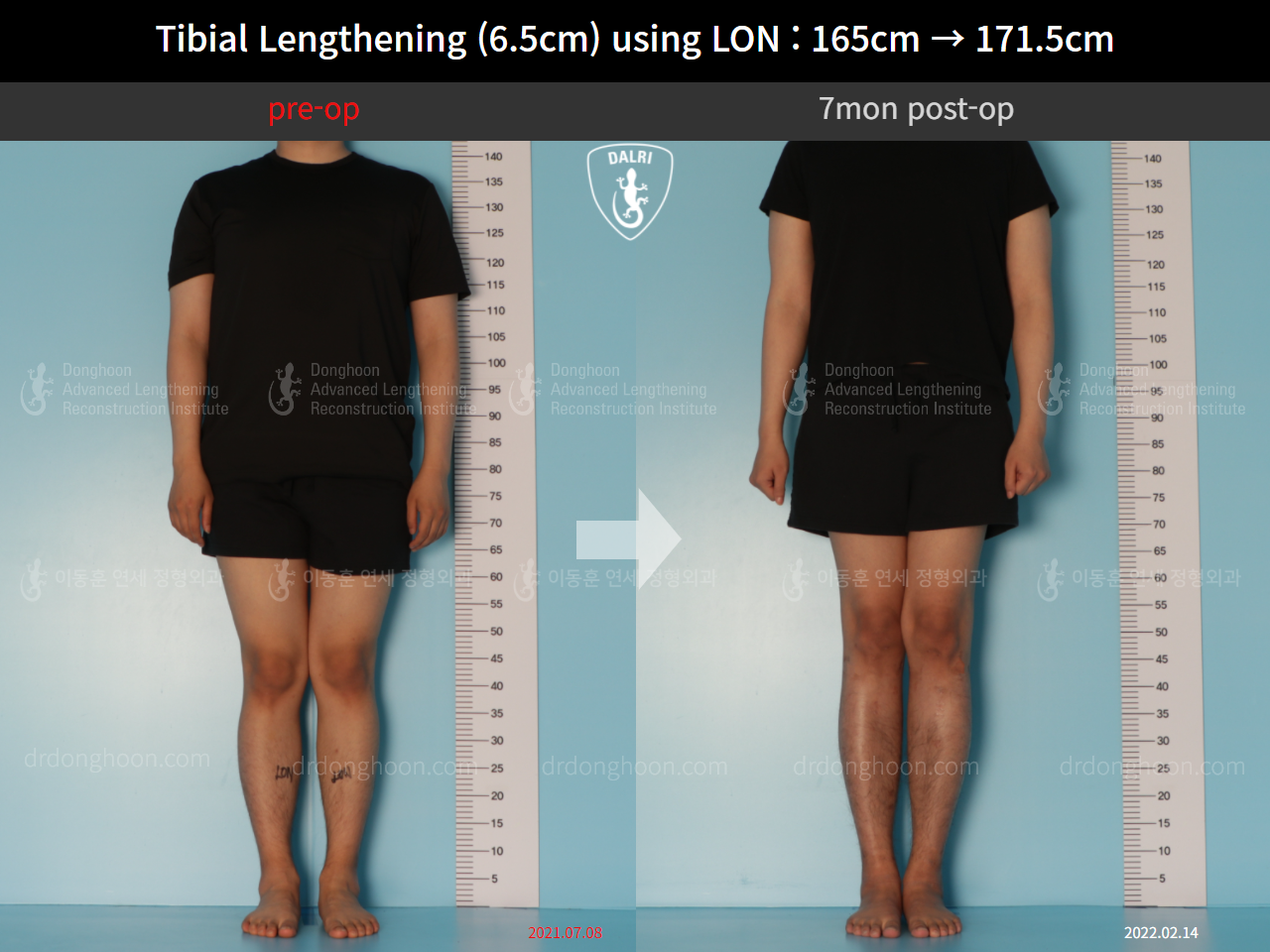 Before and after cll lon, case 10388000, image 1, Dr. Donghoon institute (DALRI)