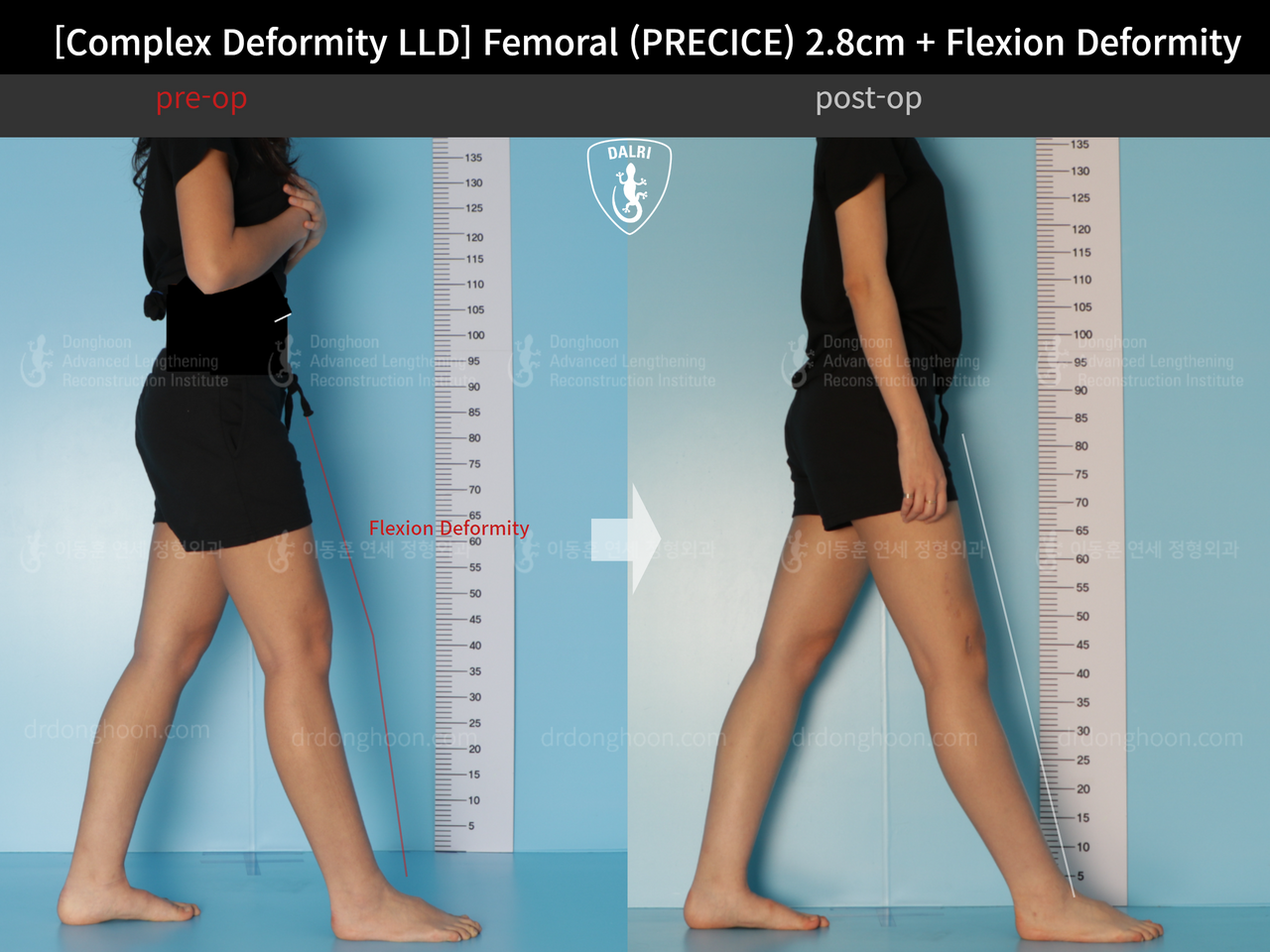 Before and after complex deformity, case 13168223, image 3, Dr. Donghoon institute (DALRI)