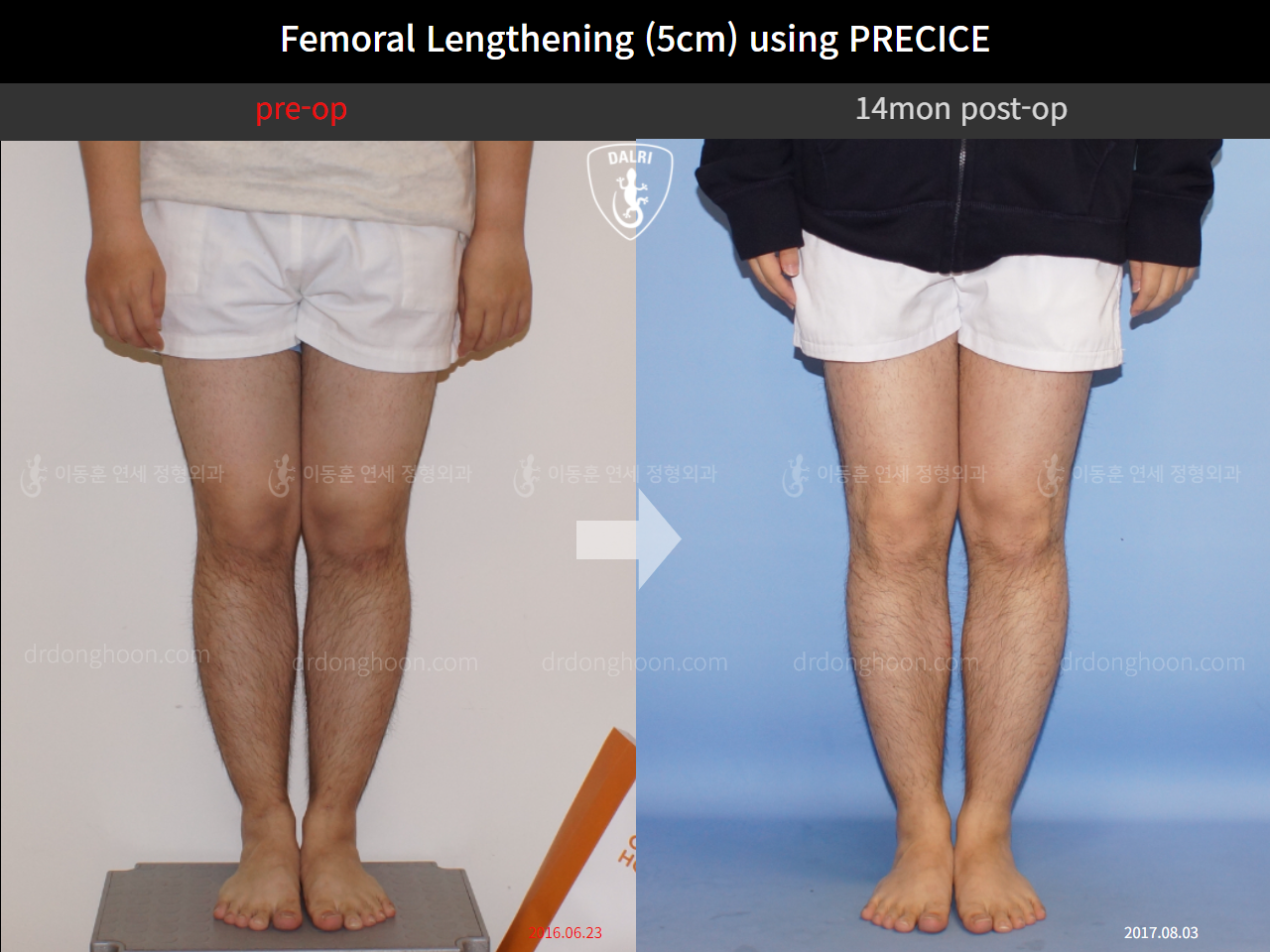 Before and after cll precice, case 4323249, image 5, Dr. Donghoon institute (DALRI)