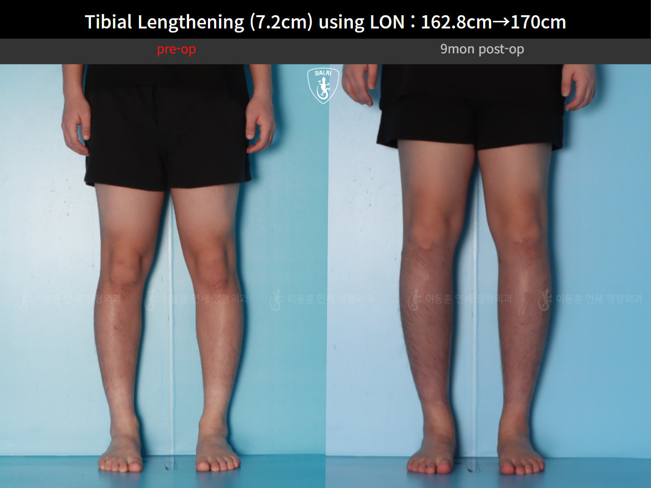 Before and after cll lon, case 124820559, image 6, Dr. Donghoon institute (DALRI)