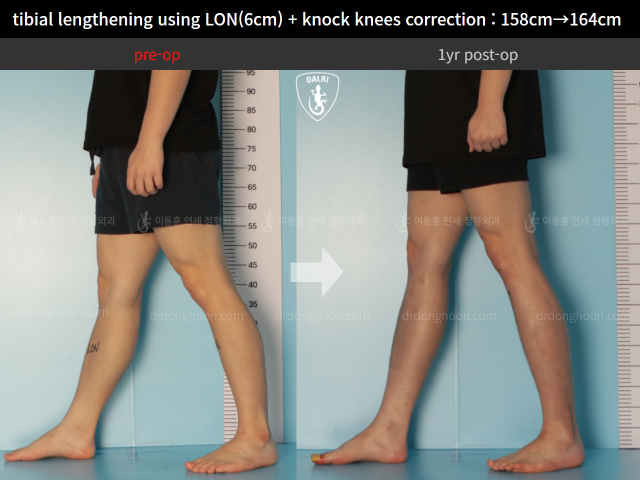 Before and after cll + deformity correction, case 9324521, image 8, Dr. Donghoon institute (DALRI)