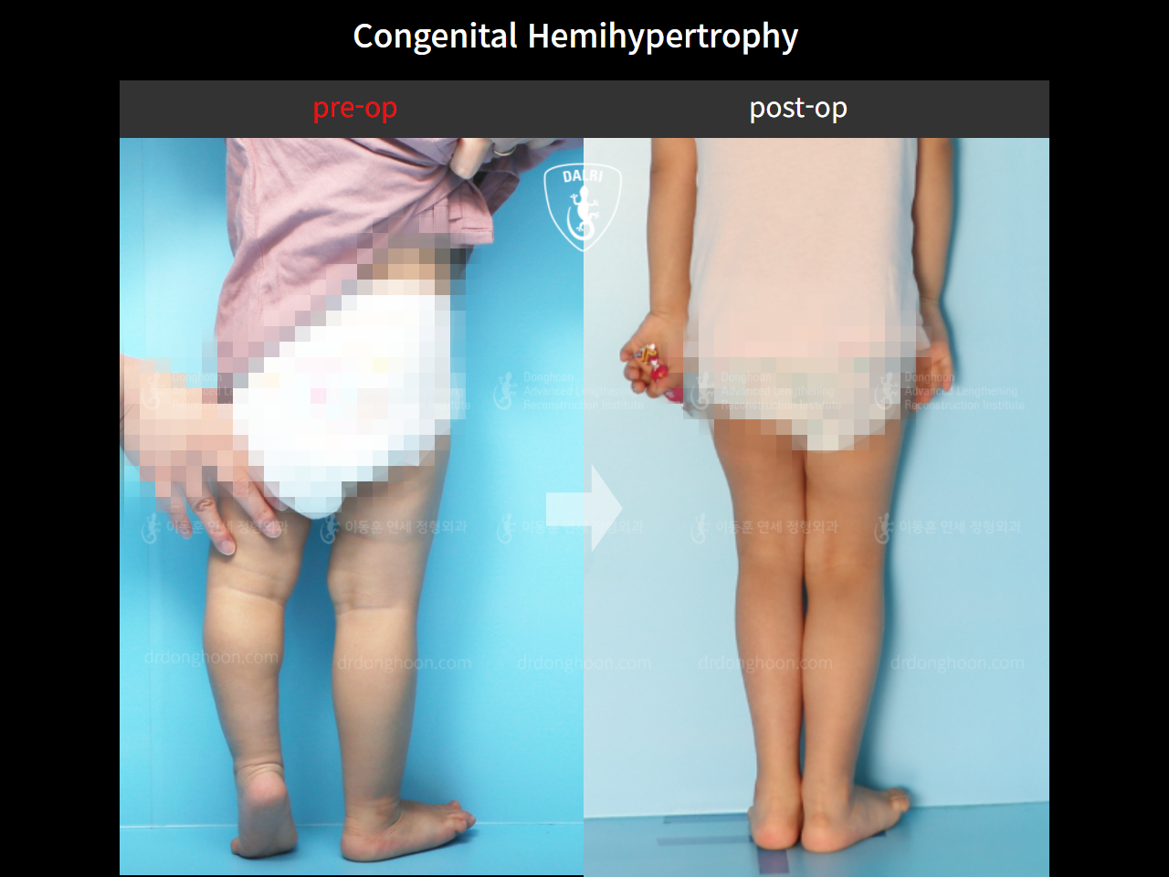 Before and after paediatric & adolescent lld, case 9478915, image 4, Dr. Donghoon institute (DALRI)