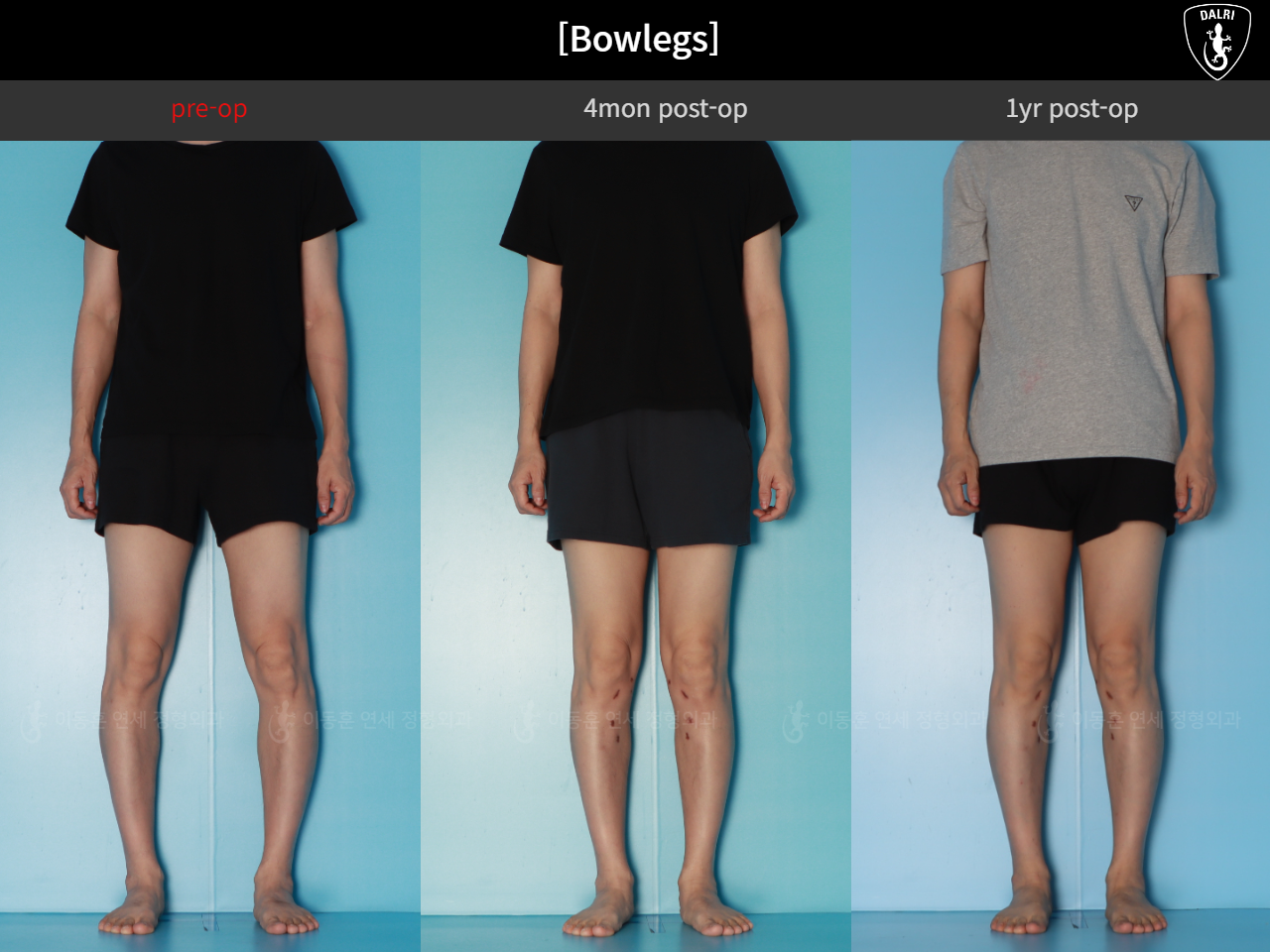 Before and after adult bowlegs, case 125438866, image 3, Dr. Donghoon institute (DALRI)