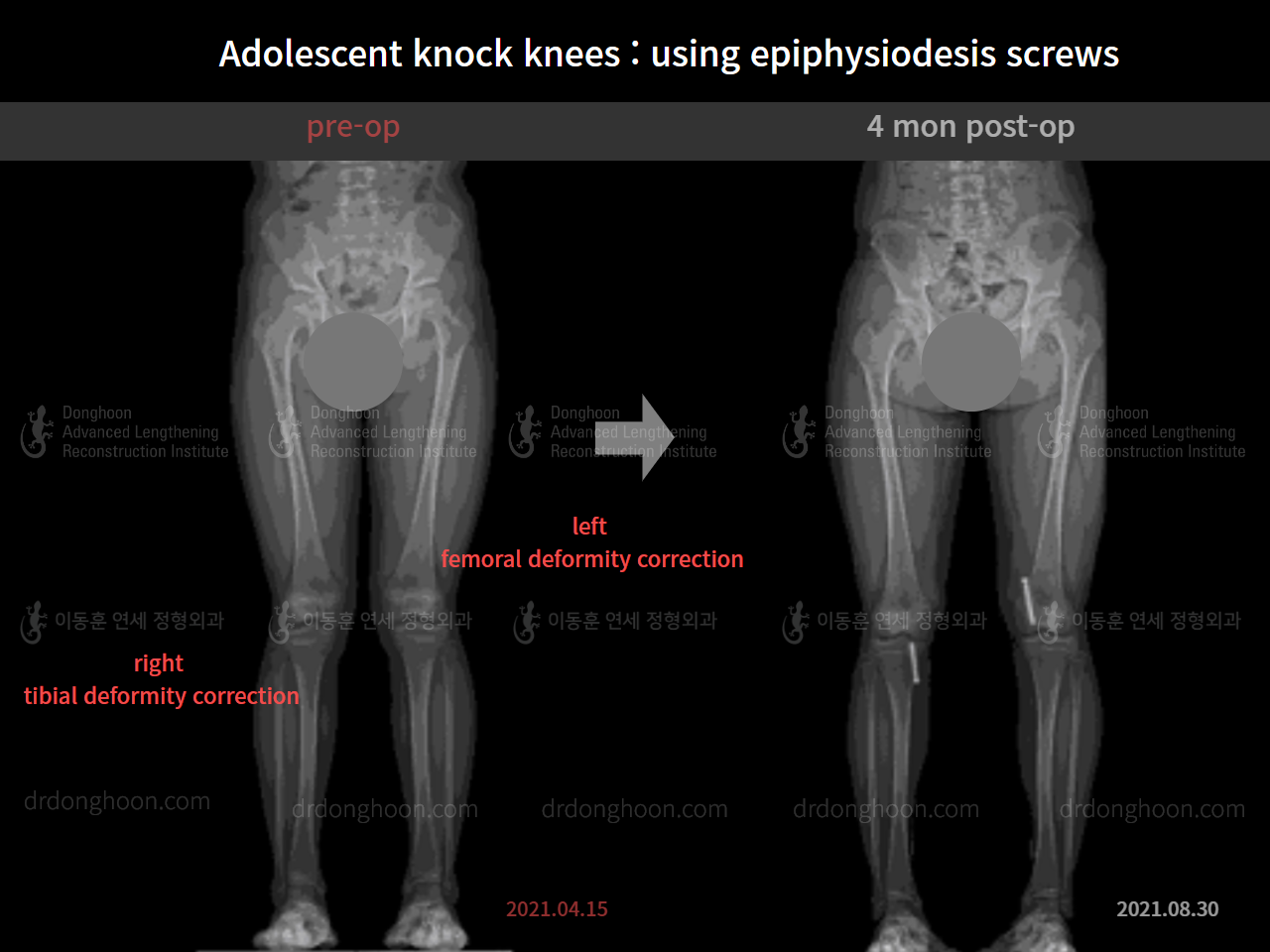 Before and after paediatric & adolescent knock knees, case 7977107, image 6, Dr. Donghoon institute (DALRI)