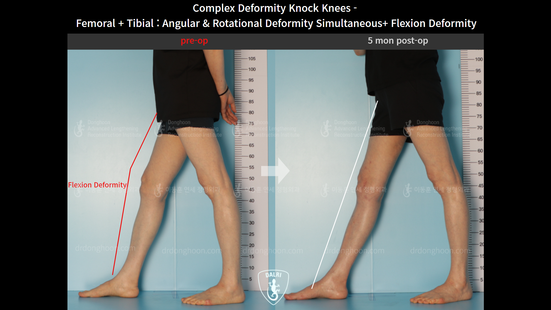 Before and after complex deformity, case 9153815, image 3, Dr. Donghoon institute (DALRI)