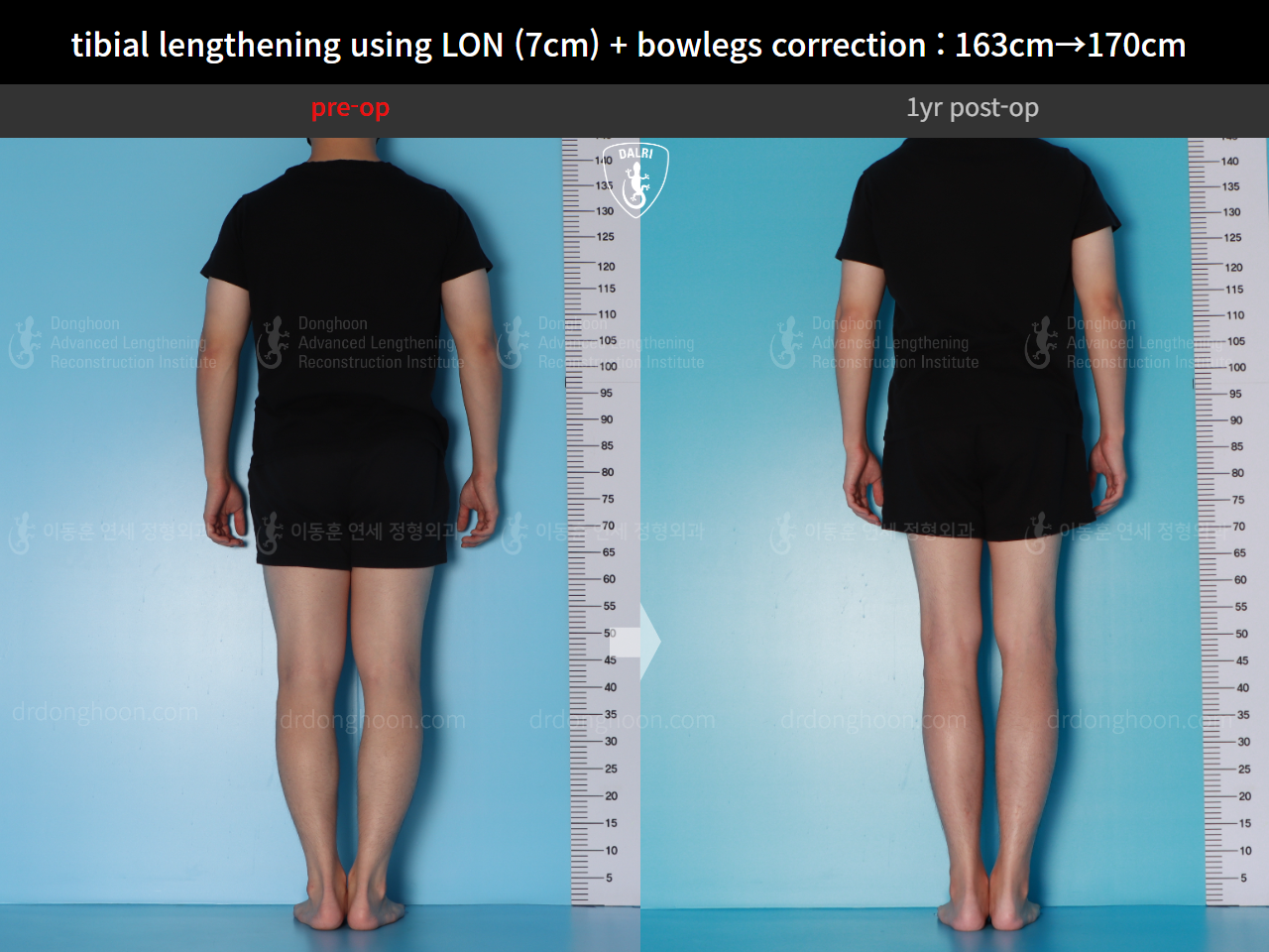 Before and after cll lon, case 16131902, image 3, Dr. Donghoon institute (DALRI)