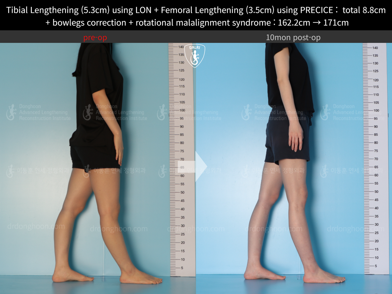Before and after cll + deformity correction, case 13127167, image 6, Dr. Donghoon institute (DALRI)
