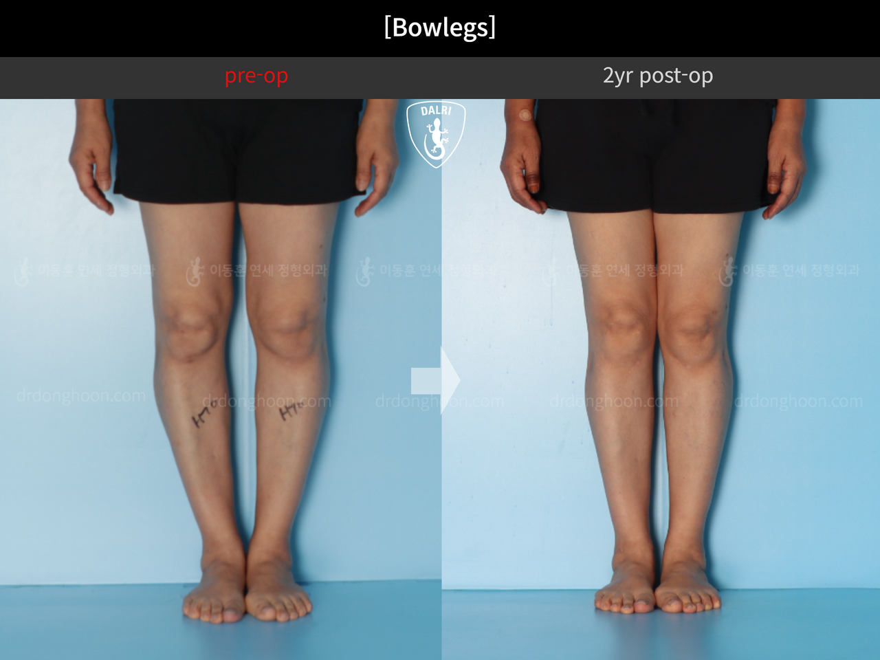 Before and after adult bowlegs, case 13250883, image 5, Dr. Donghoon institute (DALRI)