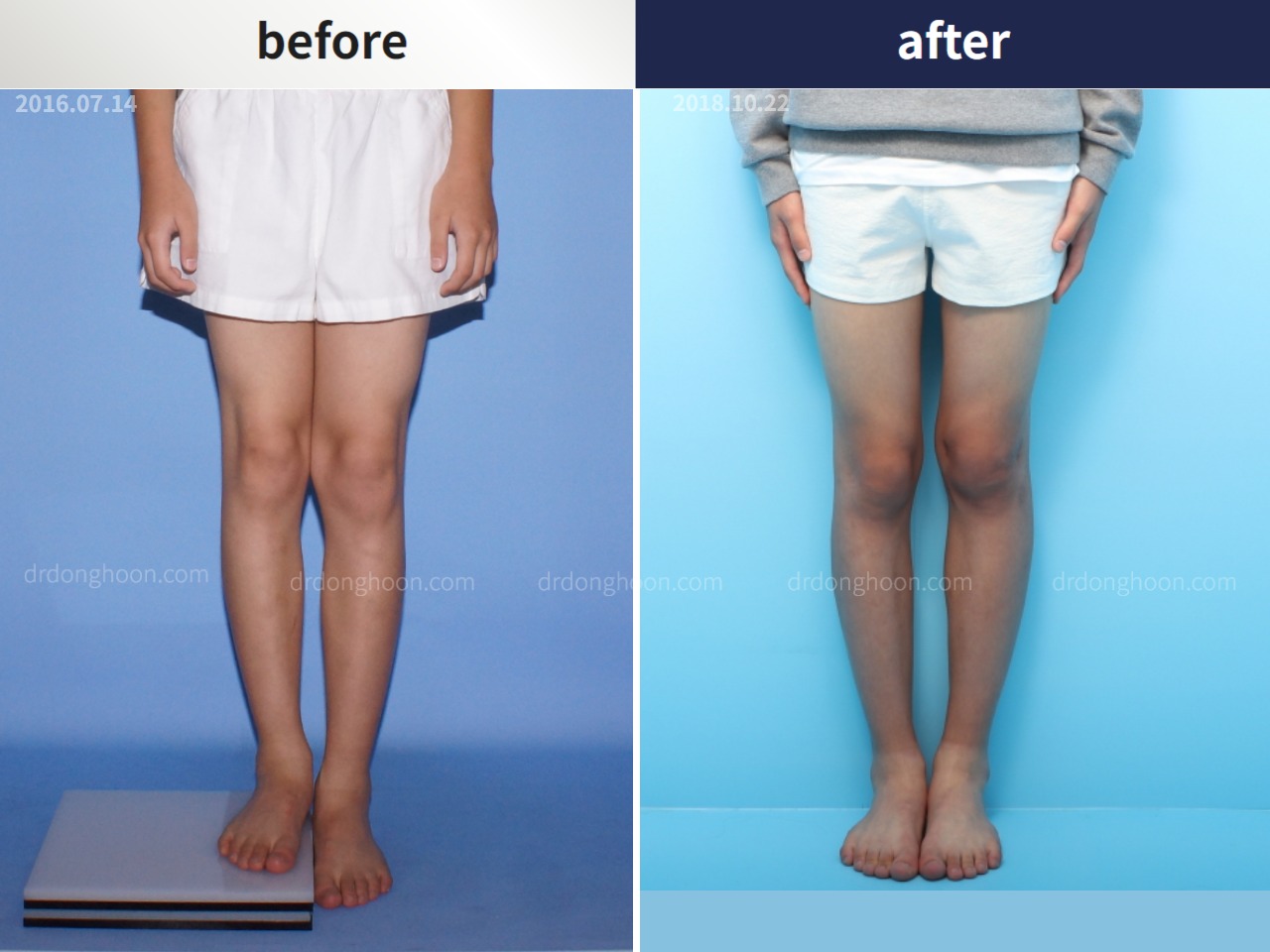 Before and after paediatric & adolescent lld, case 4320388, image 3, Dr. Donghoon institute (DALRI)