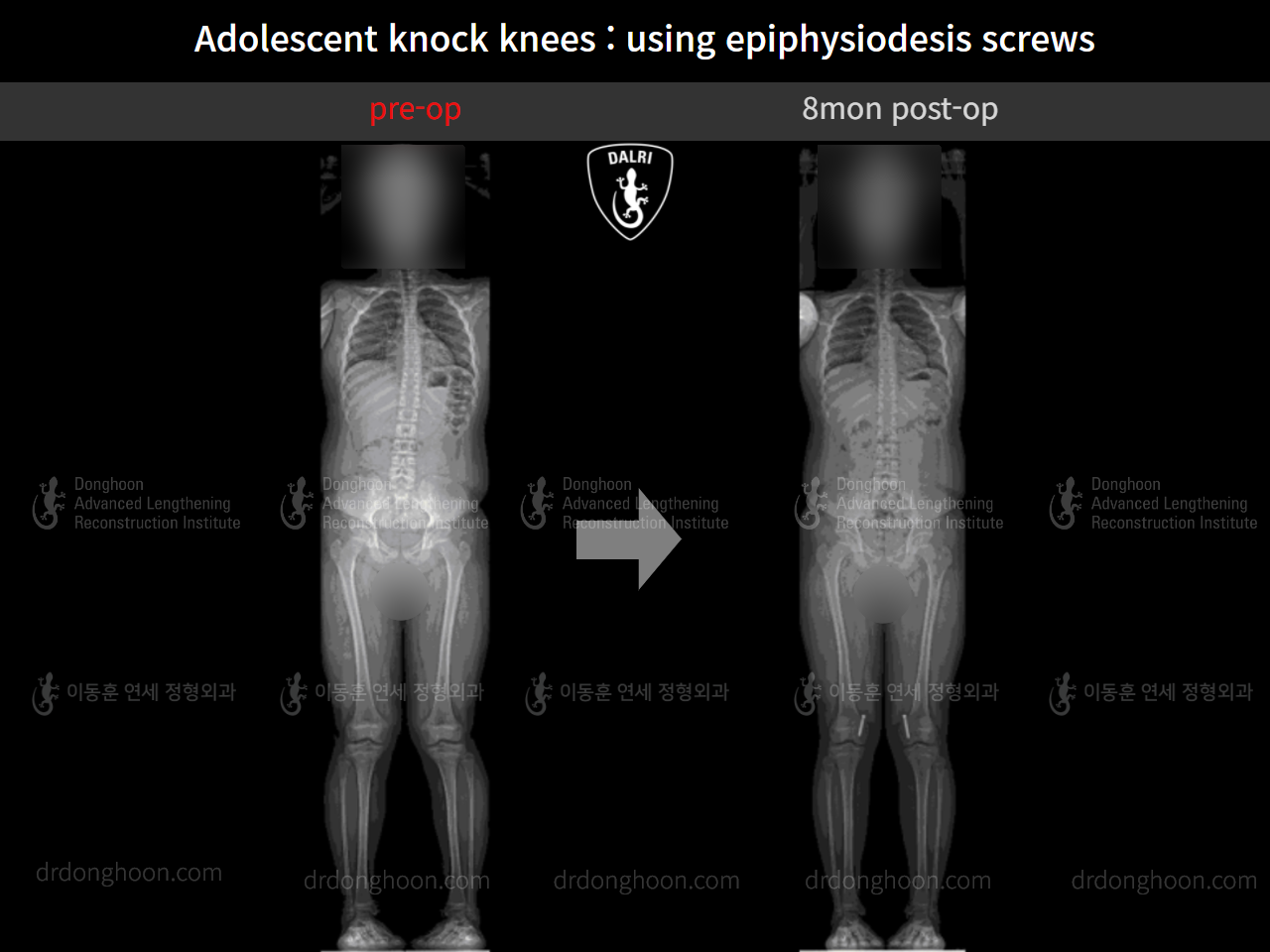 Before and after paediatric & adolescent knock knees, case 9743785, image 5, Dr. Donghoon institute (DALRI)