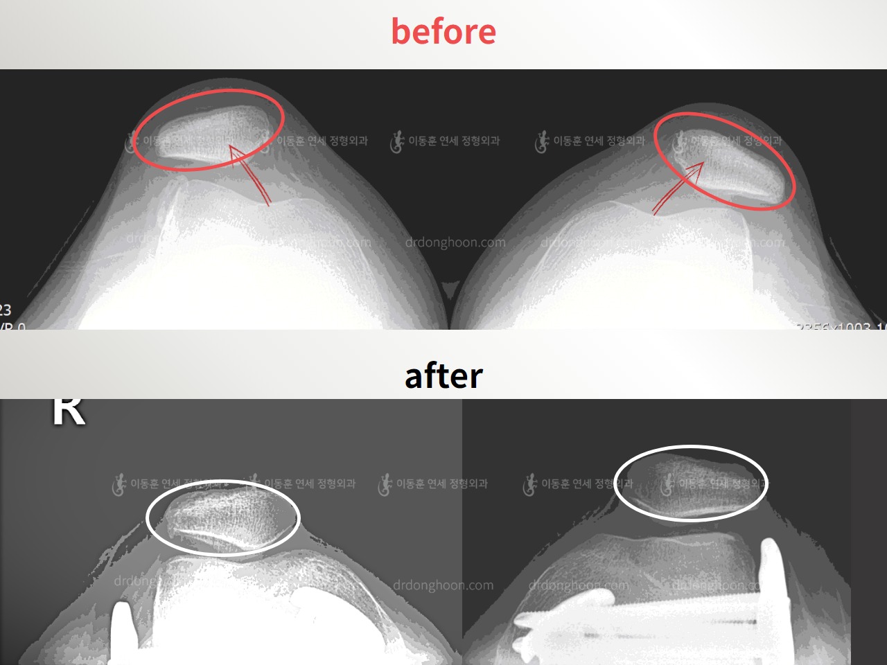 Before and after recurrent patella dislocation, case 4594087, image 1, Dr. Donghoon institute (DALRI)