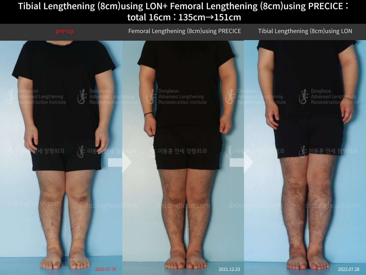 Before and after cll precice, case 12493963, image 1, Dr. Donghoon institute (DALRI)