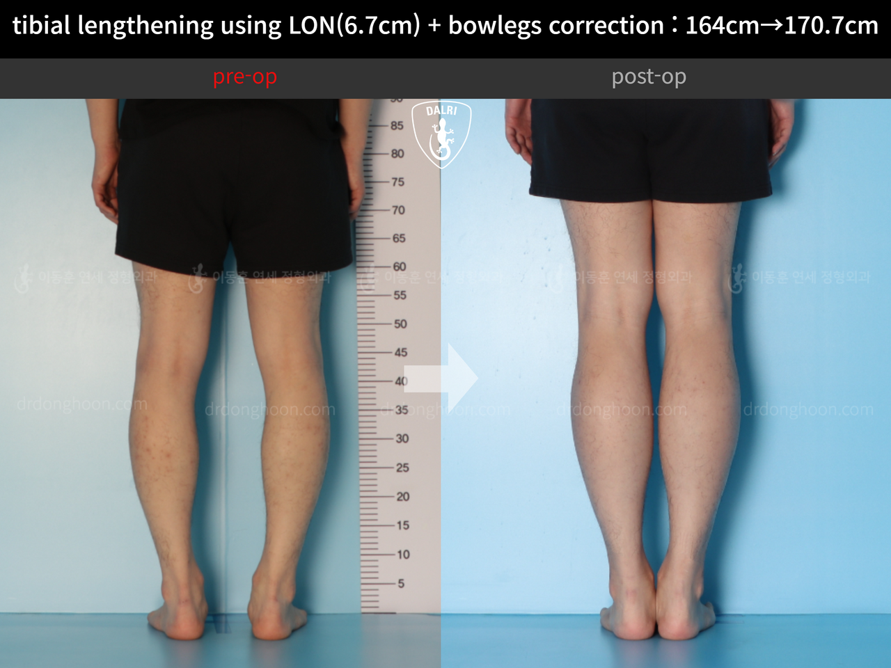 Before and after cll + deformity correction, case 13914972, image 8, Dr. Donghoon institute (DALRI)