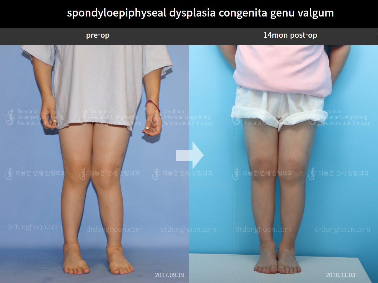 Before and after adult knock knees, case 8130481, image 1, Dr. Donghoon institute (DALRI)