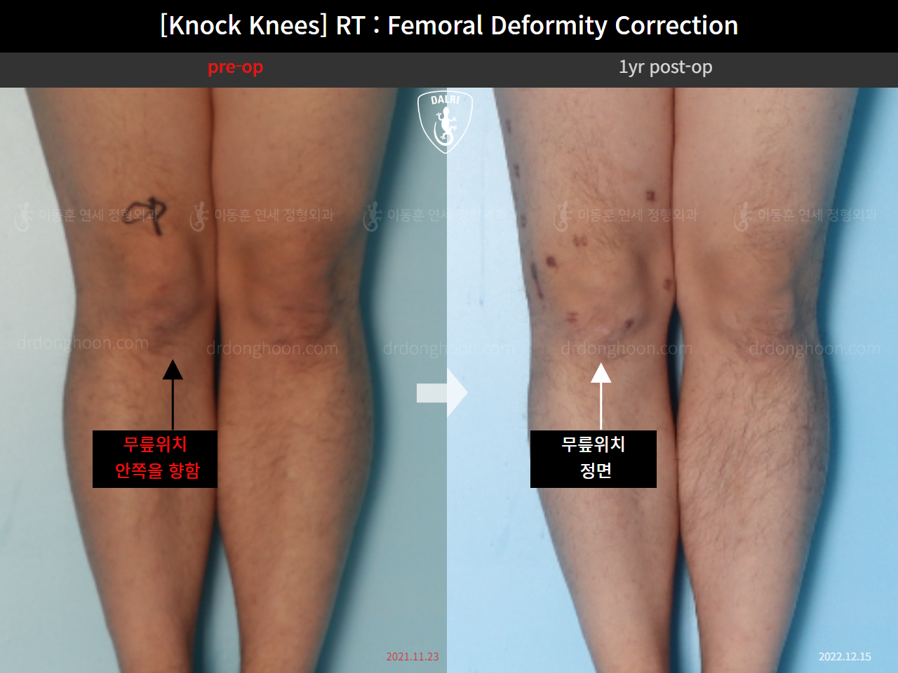 Before and after adult knock knees, case 15950751, image 3, Dr. Donghoon institute (DALRI)