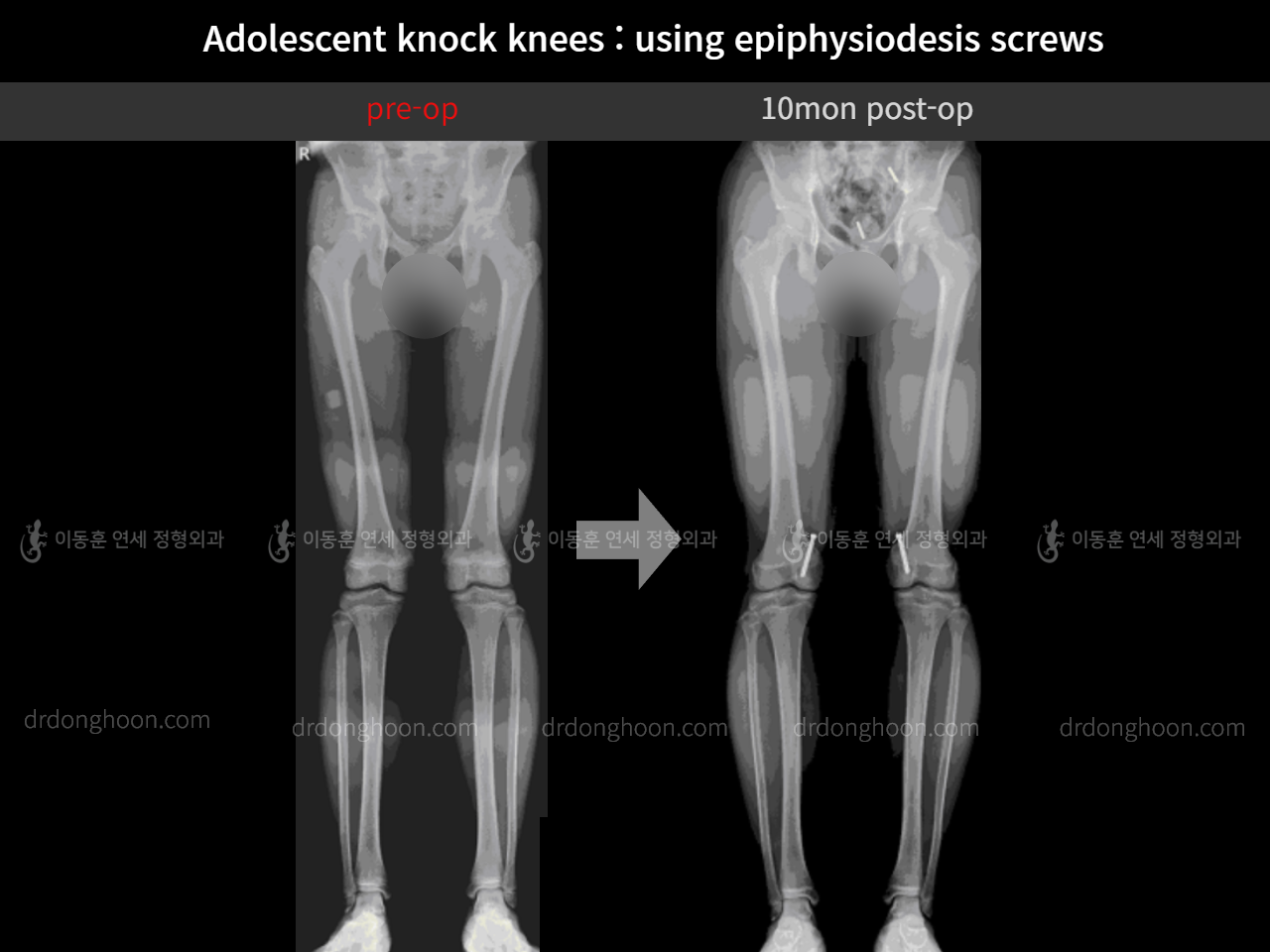 Before and after paediatric & adolescent knock knees, case 11511975, image 5, Dr. Donghoon institute (DALRI)