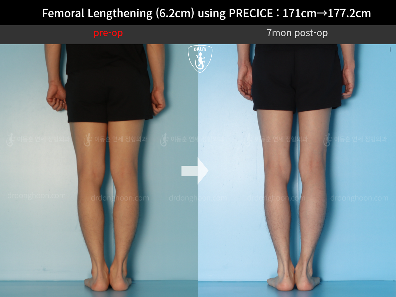 Before and after cll precice, case 13325833, image 10, Dr. Donghoon institute (DALRI)
