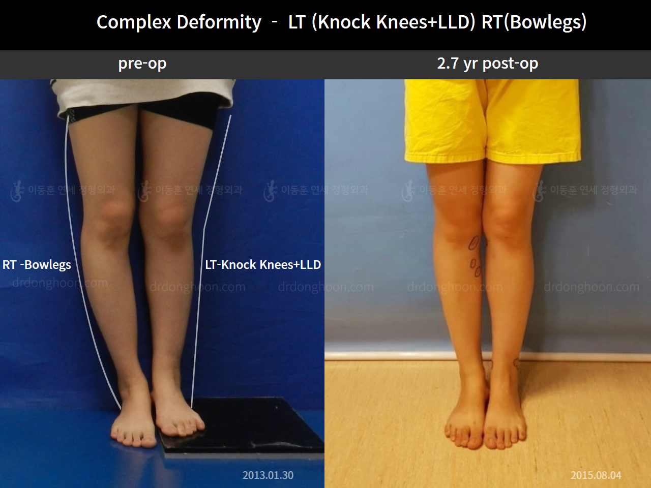 Before and after adult bowlegs, case 7382699, image 1, Dr. Donghoon institute (DALRI)