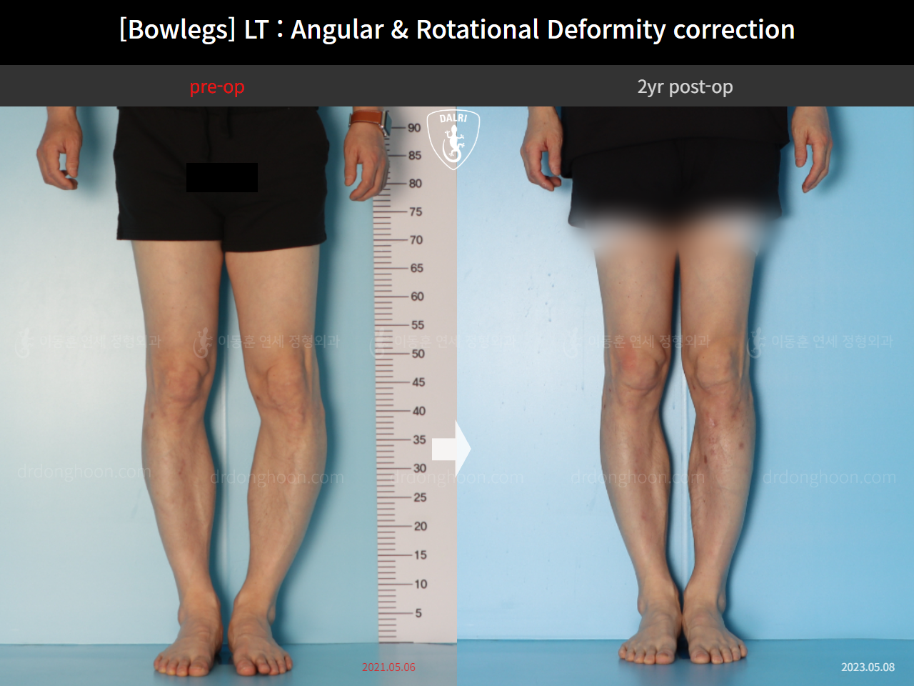 Before and after adult bowlegs, case 15111863, image 5, Dr. Donghoon institute (DALRI)