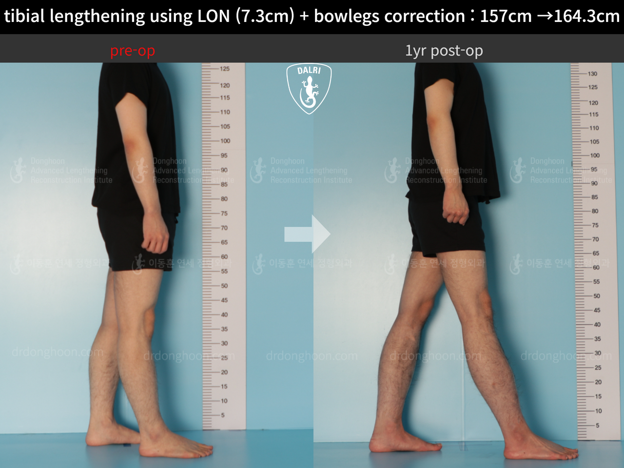Before and after cll + deformity correction, case 13152543, image 3, Dr. Donghoon institute (DALRI)