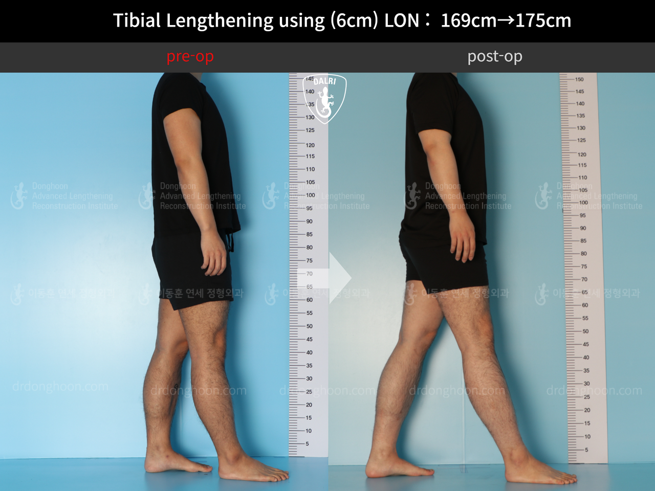 Before and after cll lon, case 12279515, image 3, Dr. Donghoon institute (DALRI)
