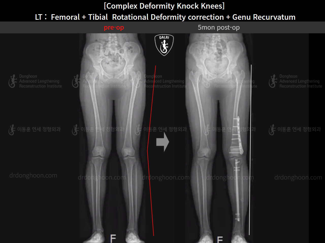 Before and after genu recurvatum, case 16212778, image 14, Dr. Donghoon institute (DALRI)