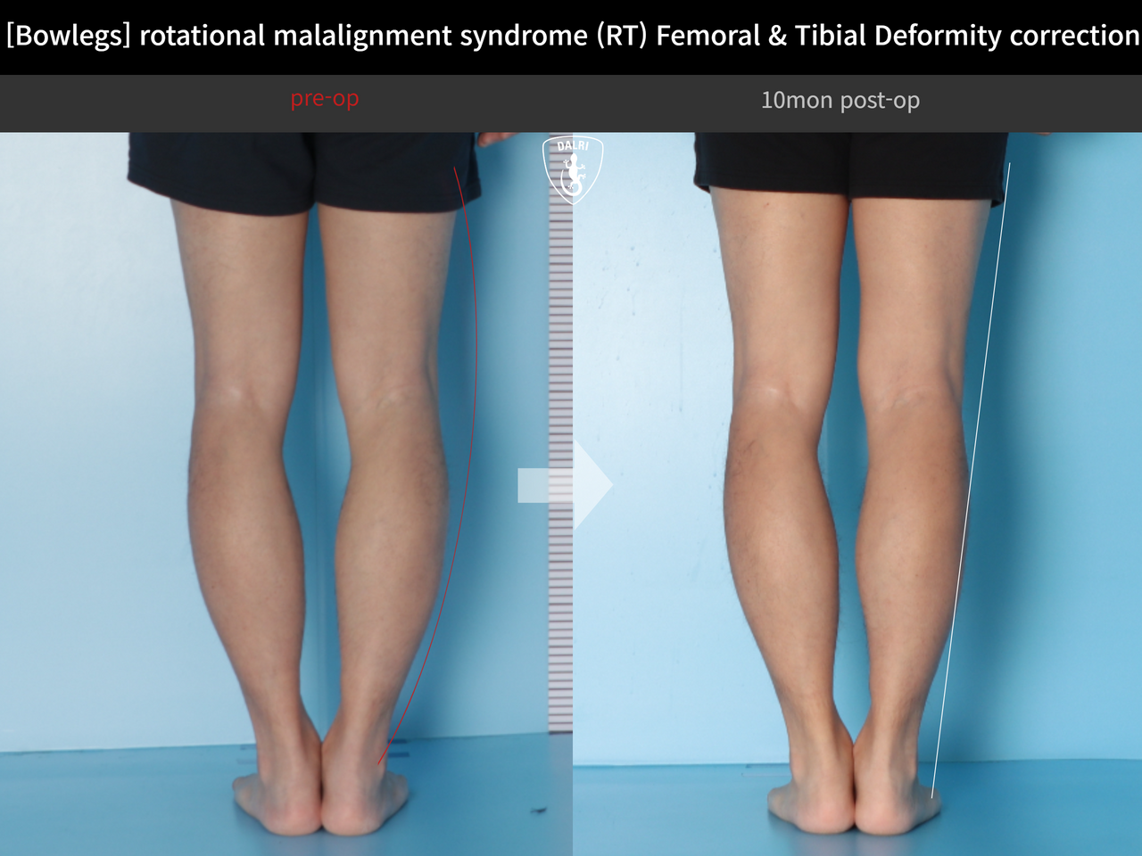 Before and after adult bowlegs, case 14220550, image 6, Dr. Donghoon institute (DALRI)