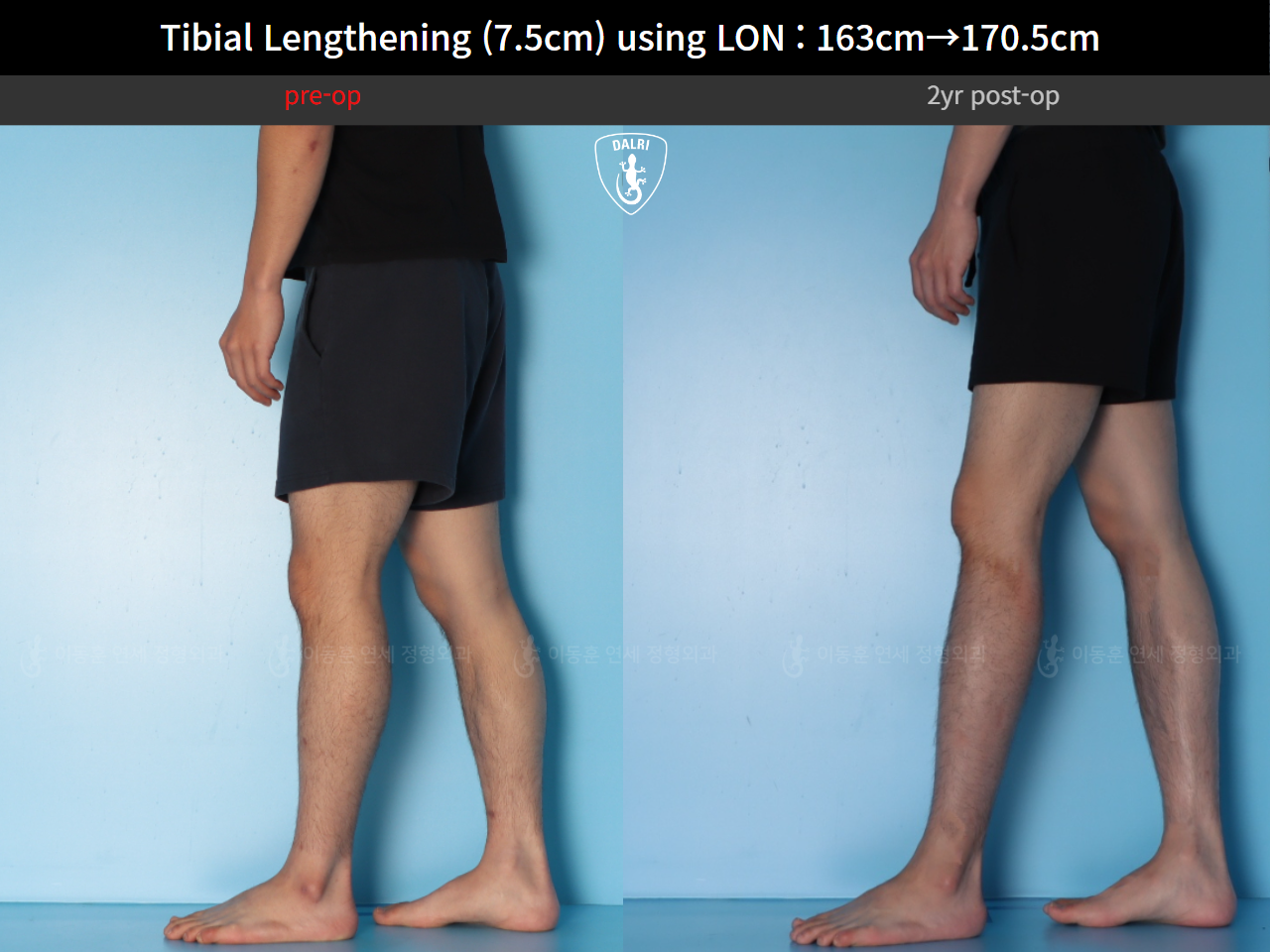 Before and after cll lon, case 125785462, image 11, Dr. Donghoon institute (DALRI)