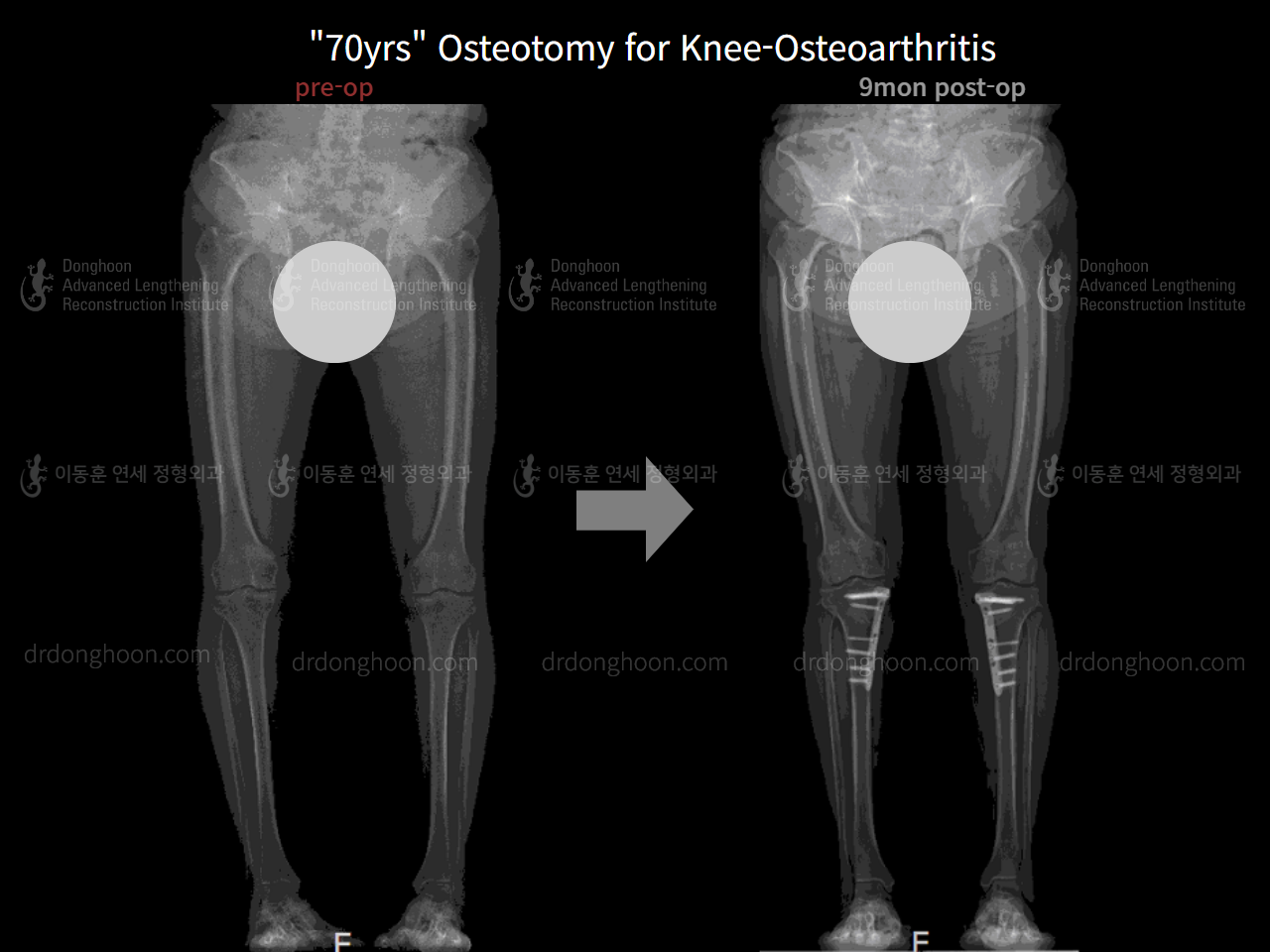 Before and after osteotomy for knee osteoarthritis, case 4306392, image 6, Dr. Donghoon institute (DALRI)