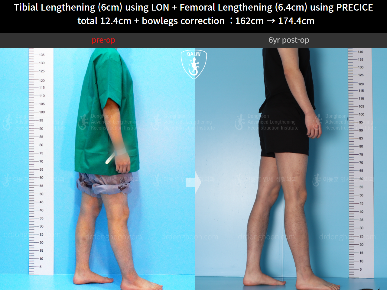 Before and after cll precice, case 14631295, image 7, Dr. Donghoon institute (DALRI)