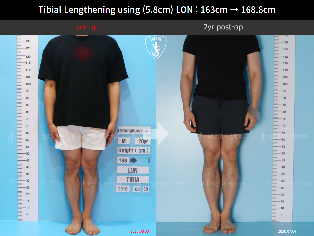 Before and after cll lon, case 11468172, image 1, Dr. Donghoon institute (DALRI)
