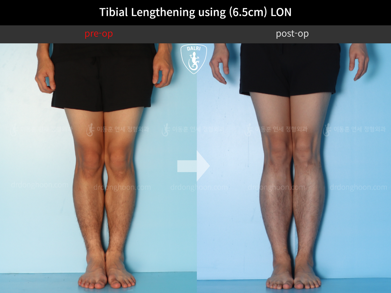 Before and after cll lon, case 12242145, image 4, Dr. Donghoon institute (DALRI)