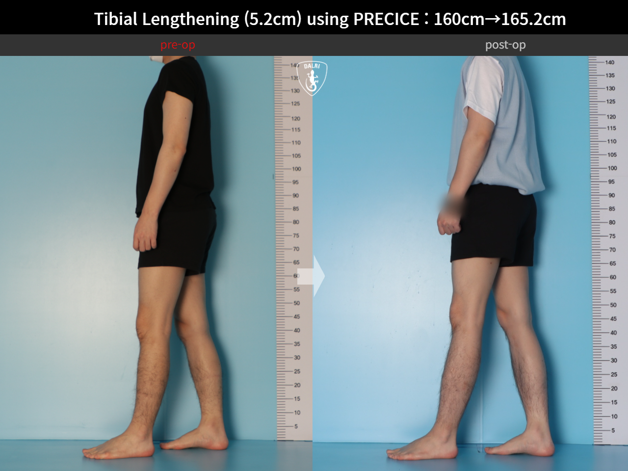 Before and after cll precice, case 27370351, image 4, Dr. Donghoon institute (DALRI)
