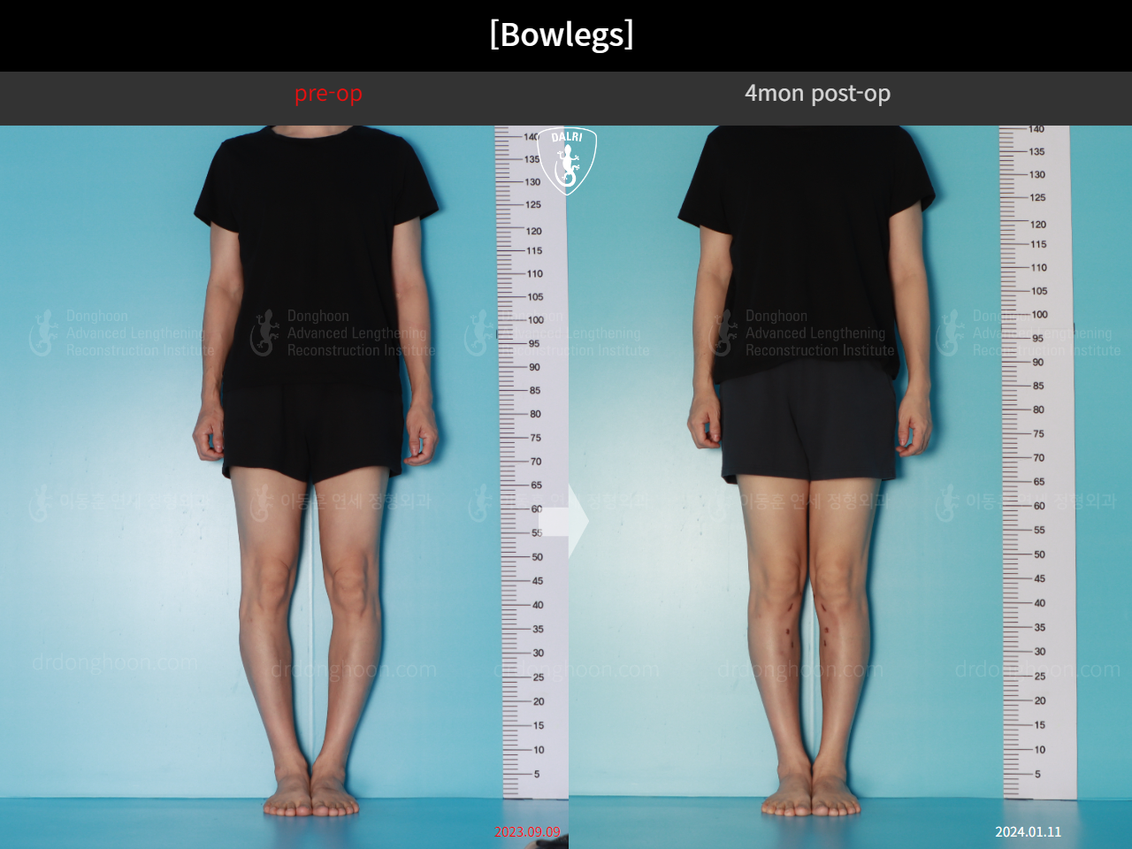 Before and after adult bowlegs, case 17962599, image 1, Dr. Donghoon institute (DALRI)