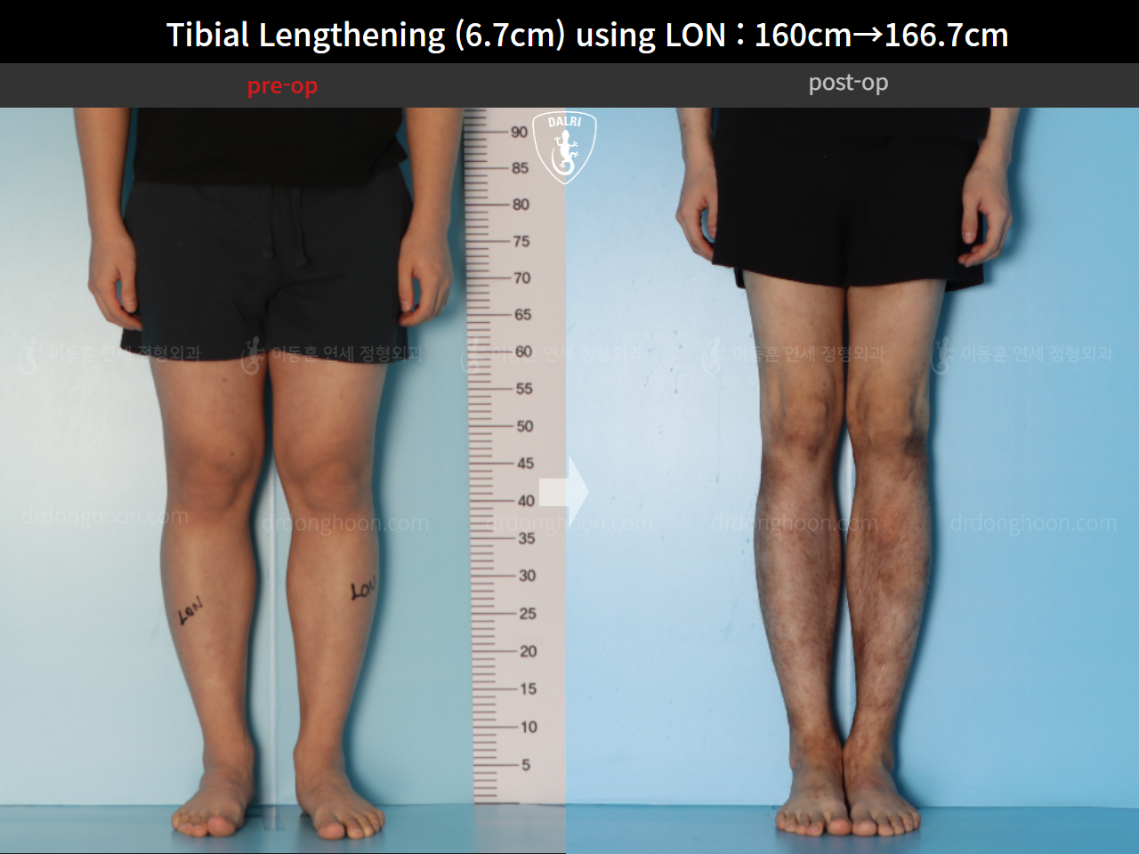 Before and after cll lon, case 15544530, image 5, Dr. Donghoon institute (DALRI)